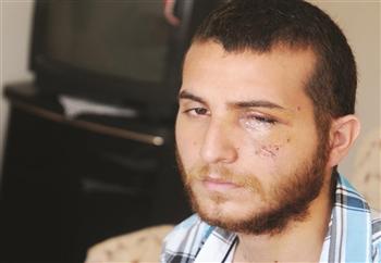 Mahir Gür, 22, lost sight in left eye due to a rubber bullet in Taksim. DAILY NEWS photo